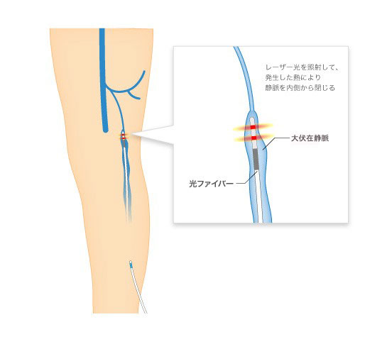 血管内レーザー焼灼術の模式図