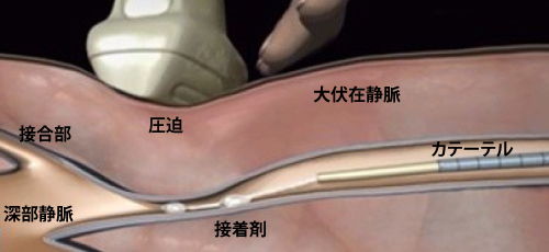 血管内塞栓術
