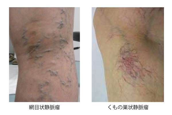 網目状静脈瘤・くもの巣状静脈瘤