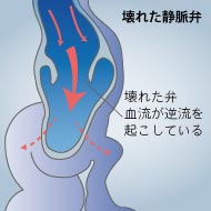 壊れた静脈弁