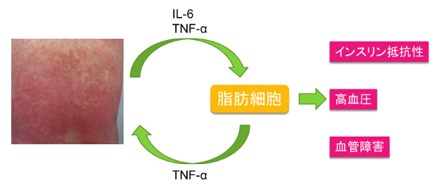 乾癬および乾癬性関節炎の治療