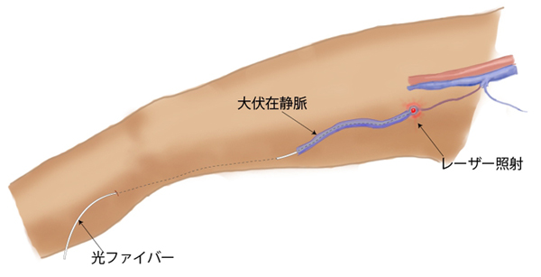 レーザー治療
