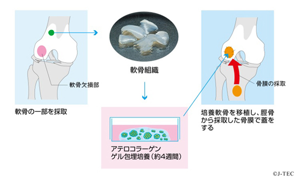 自家培養軟骨を使った治療
